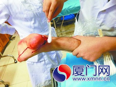 腳底一滑跟腱斷裂
