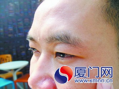 梁先生認(rèn)為，打針后，他眼睛下的皺紋并未減少。