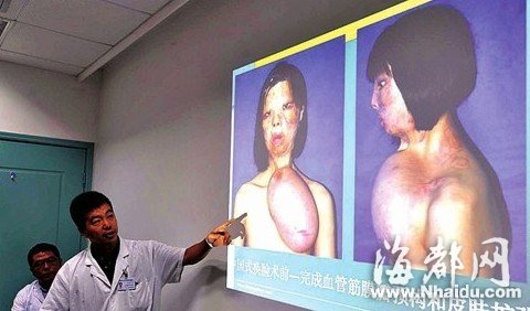 醫(yī)院為小梅完成了血管筋膜瓣預(yù)構(gòu)和皮膚的擴(kuò)張