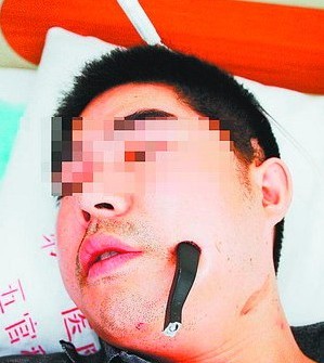 7厘米長車把戳入臉部