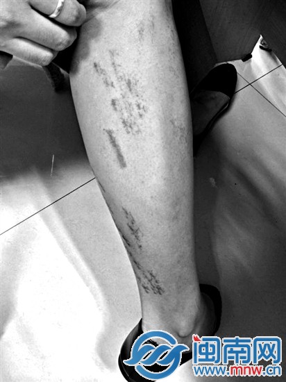 黃小姐小腿前后均有類(lèi)似的血痕