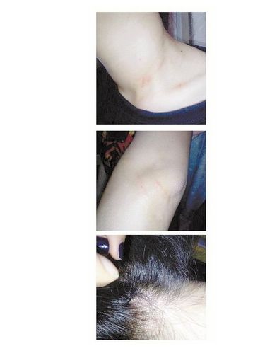 網(wǎng)友微博曬被“女瘋子”抓傷的部位