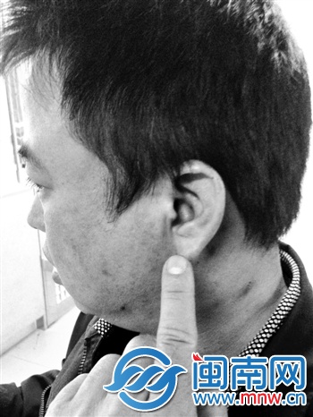 雷師傅經檢查，為左耳膜開放性損傷