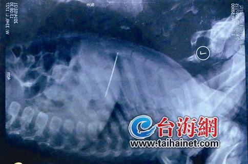 5厘米長縫衣針扎入小孩內臟 醫(yī)生為難如何取針2