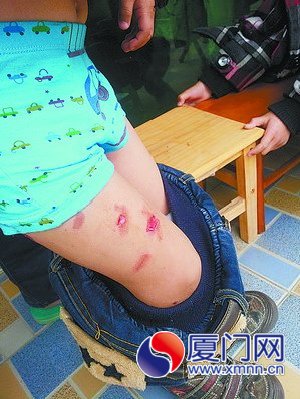 小毅被咬得遍體鱗傷