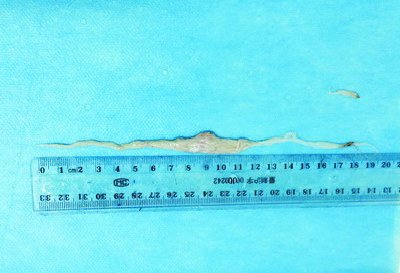 圖為從蔡先生氣管中取出的紗布條