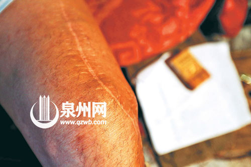 幾年前出車禍腿斷了，醫(yī)療用的鋼板至今仍在腿內(nèi)