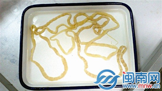 李女士排出的整條絳蟲，長(zhǎng)約2.5米